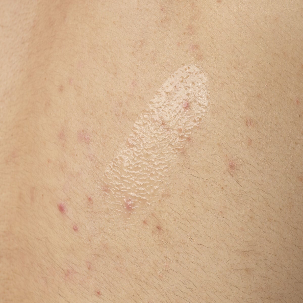 salicylic-acid-0-5-body-serum-a4 ORD-salicylic-acid-05-body-240ml-application.jpg