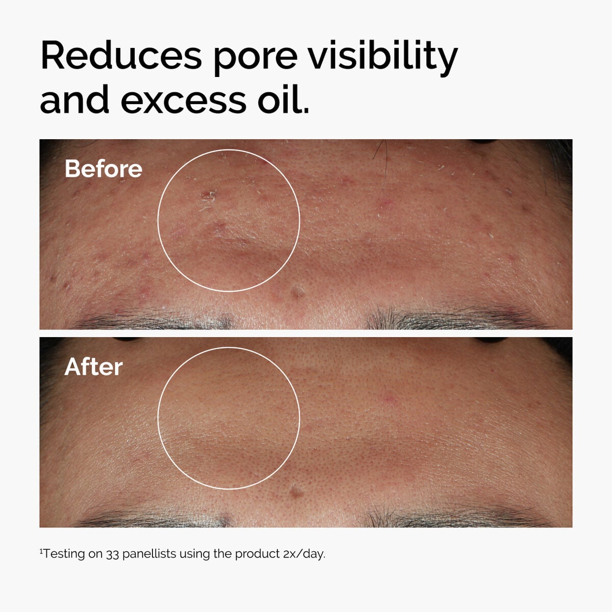 niacinamide-10-zinc-1-r8 ord-niacinamide-zinc-blemish-serum-before-after-pores.jpg