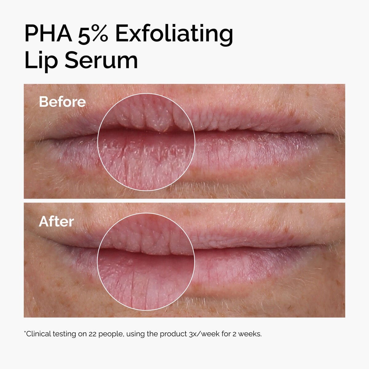 pha-5-exfoliating-lip-serum-q0 ord-pha-5pct-lip-exfoliating-serum-before-after.jpg