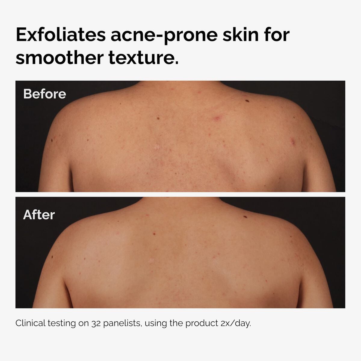 salicylic-acid-0-5-body-serum-a4 ord-salicylic-acid-body-serum-before-after-graphic-NA.jpg
