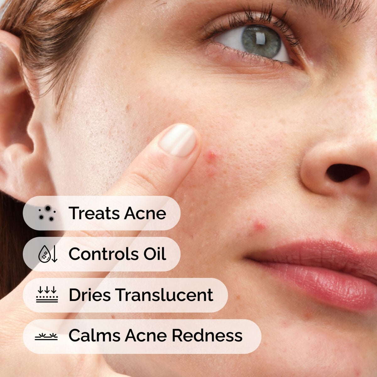 sulfur-10-powder-to-cream-concentrate-j8 ord-sulfur-10pct-powder-to-cream-concentrate-model-application-with-benefits-acne.jpg