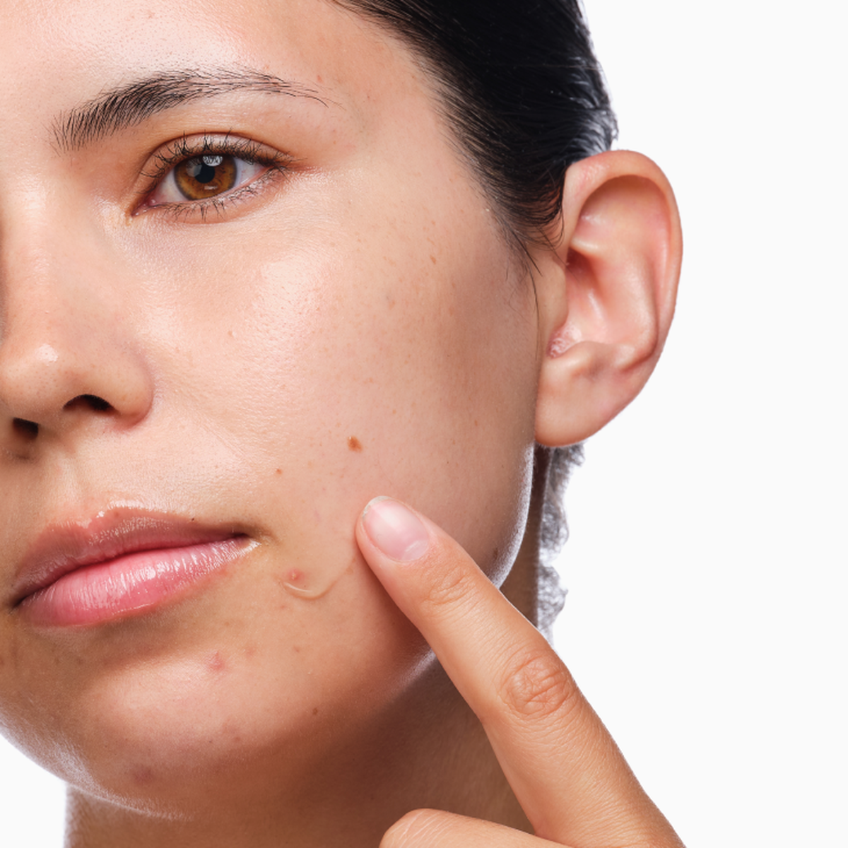 the-acne-set-i1 rdn-the-acne-set-application.png